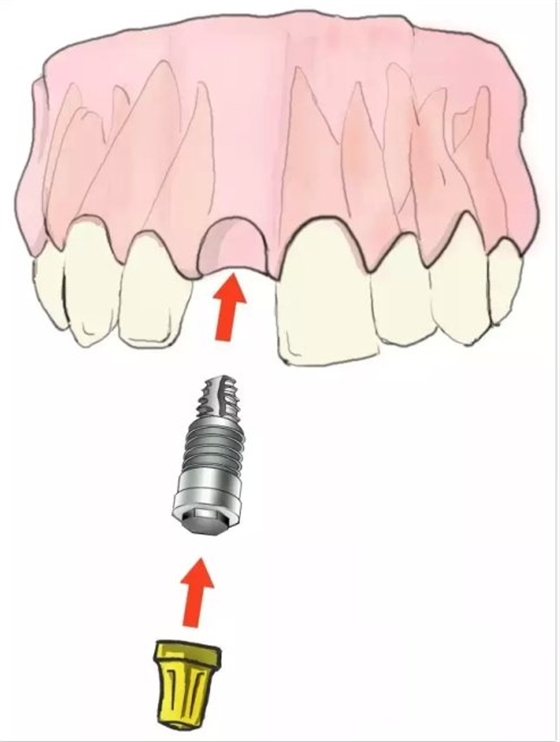 种植【最全的种植牙介绍】