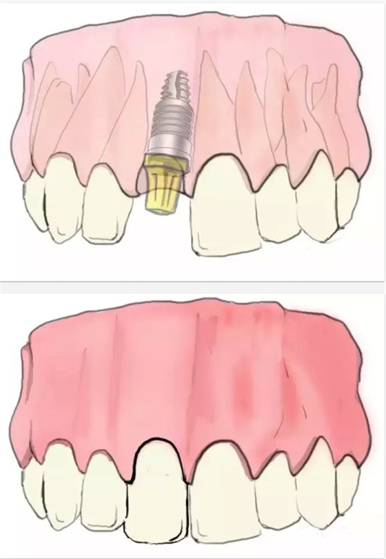 种植【最全的种植牙介绍】