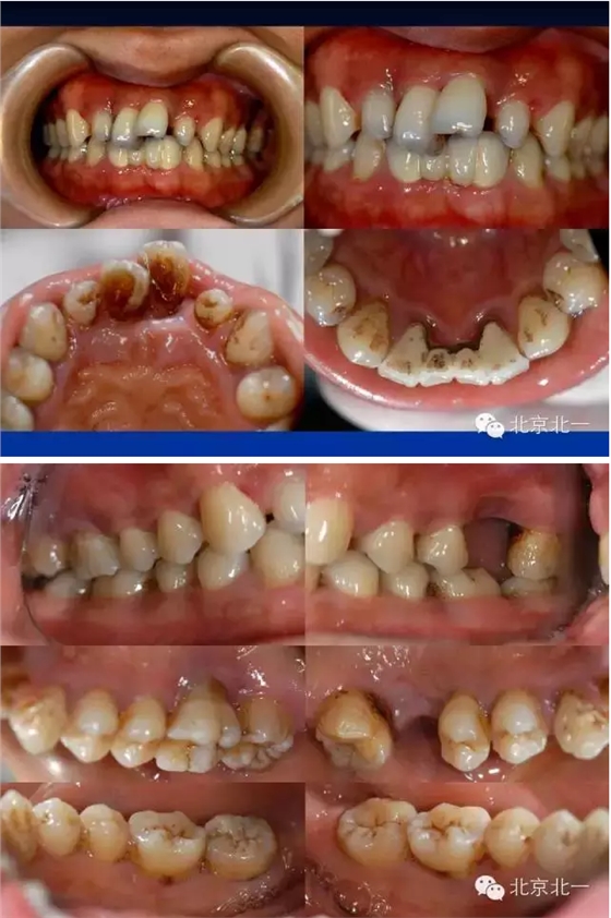 牙周基础治疗的临床病例介绍