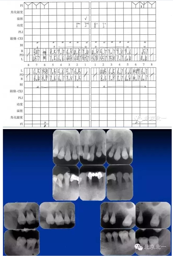 牙周基础治疗的临床病例介绍