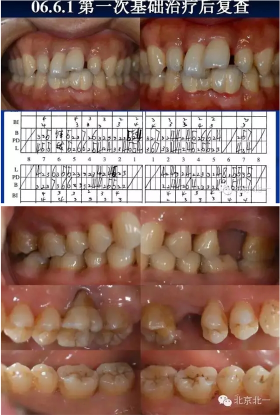 牙周基础治疗的临床病例介绍