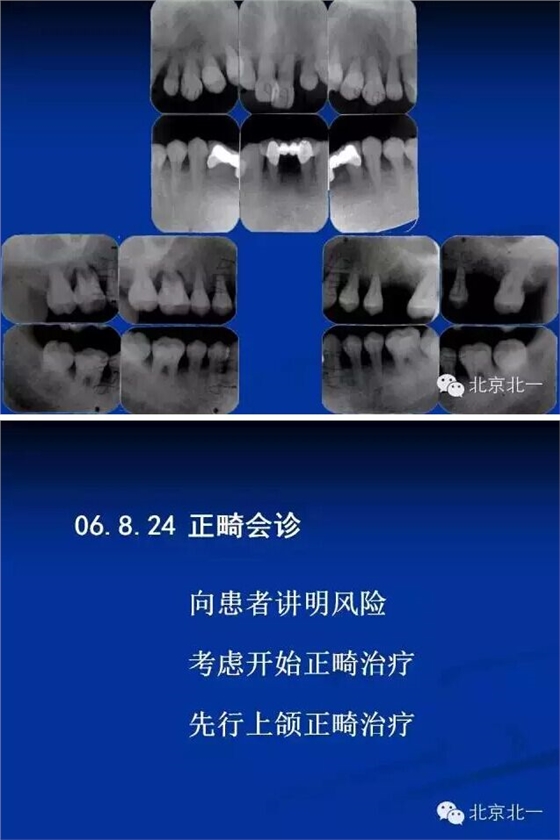 牙周基础治疗的临床病例介绍