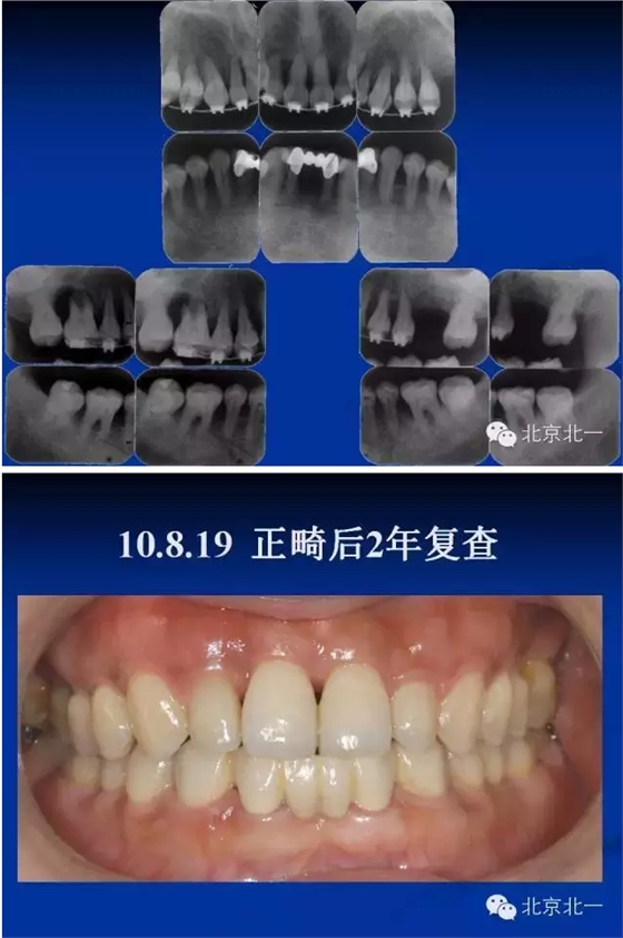 牙周基础治疗的临床病例介绍