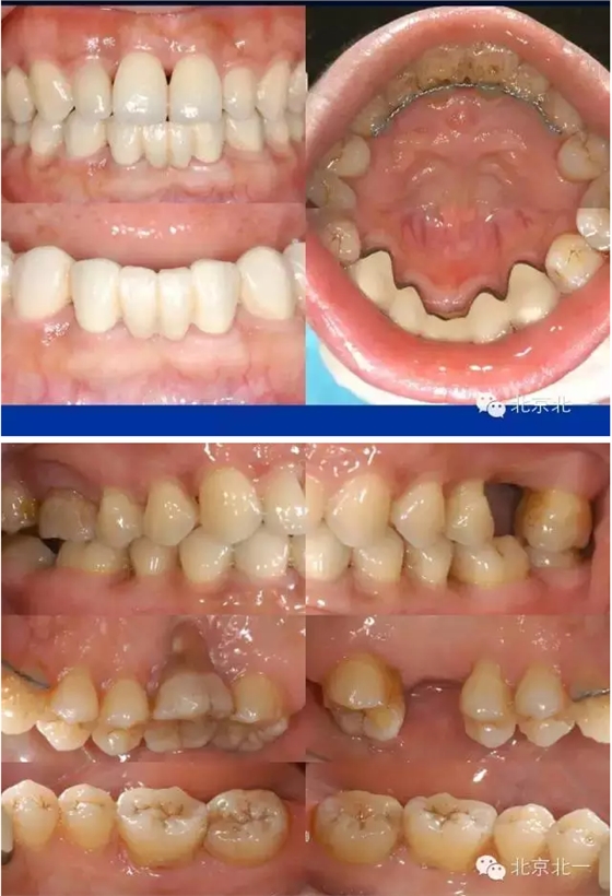 牙周基础治疗的临床病例介绍