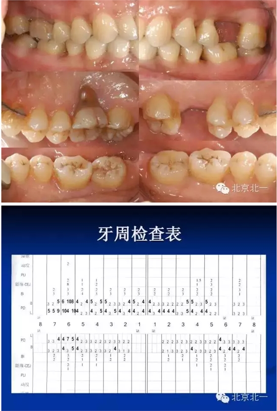 牙周基础治疗的临床病例介绍