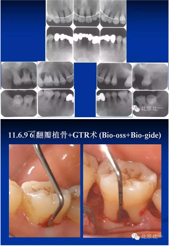 牙周基础治疗的临床病例介绍