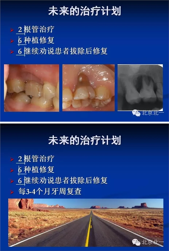 牙周基础治疗的临床病例介绍