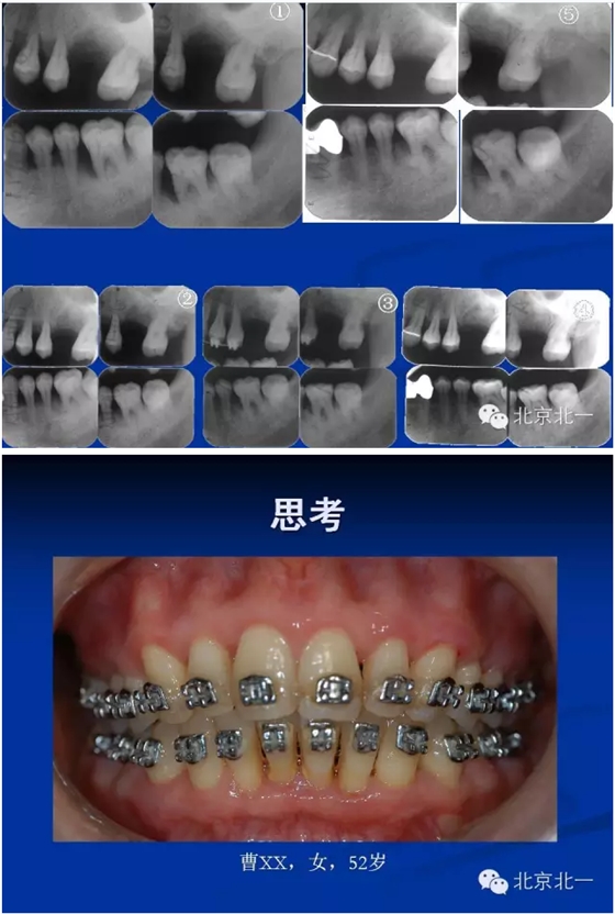 牙周基础治疗的临床病例介绍