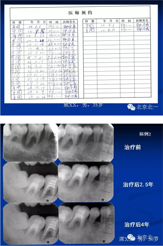 牙周基础治疗的临床病例介绍