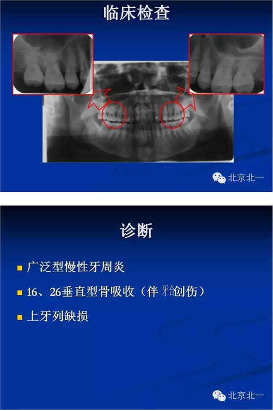 牙周基础治疗的临床病例介绍