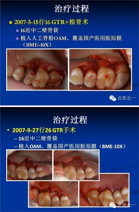 牙周基础治疗的临床病例介绍