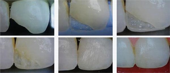 各类牙洞型树脂修复