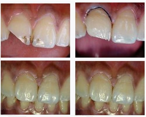 各类牙洞型树脂修复