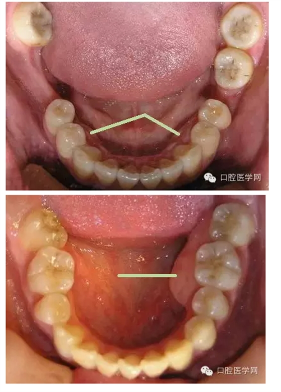 是指牙龈区域的牙槽骨出现骨质增生性突起