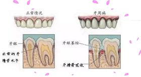 牙周病?| 天啊,你的牙齿为什么会这样?