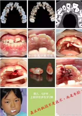 额外牙经常在上颌出现,上,下颌出现比例为10:1,可单个或多个,单侧或