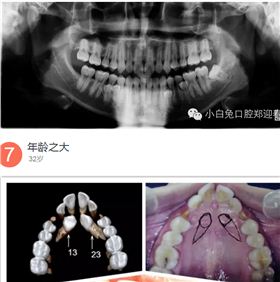 "多生牙"案例集锦(郑颖春)