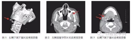 	下颌下静脉畸形伴多发静脉石误诊为涎石病1例