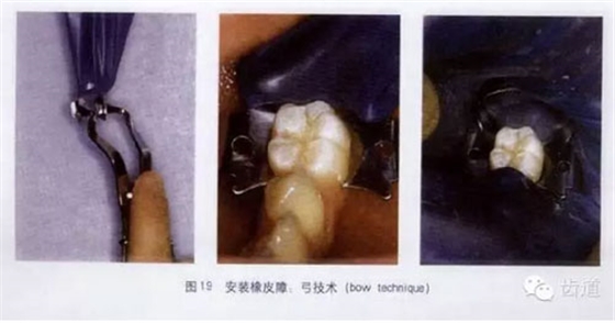 橡皮障的临床运用大全