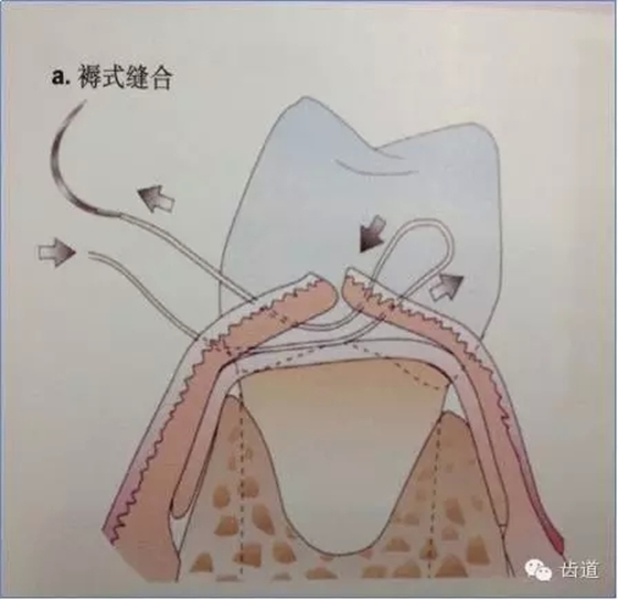 但应用改良龈乳头保存术和牙