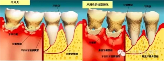 牙周炎的相关修复治疗原则