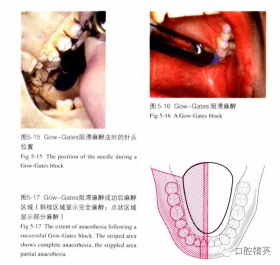 分析局部麻醉失败的常见原因