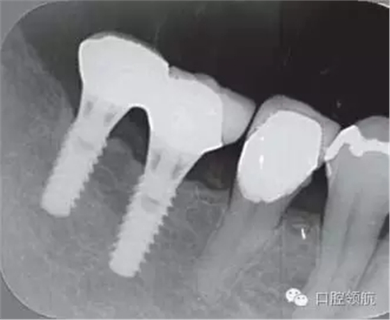 种植体周围出现伴有骨密度增加现象的骨吸收