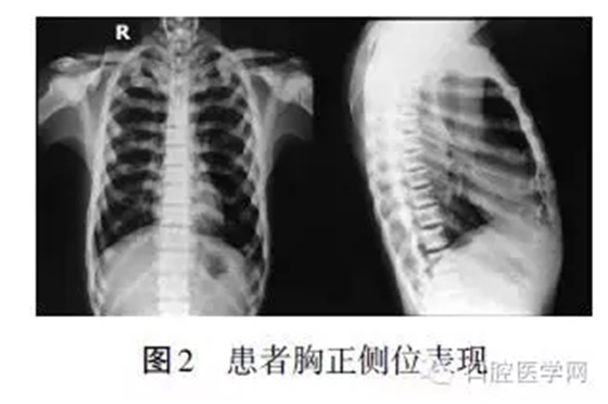 颌骨骨髓炎X线影像