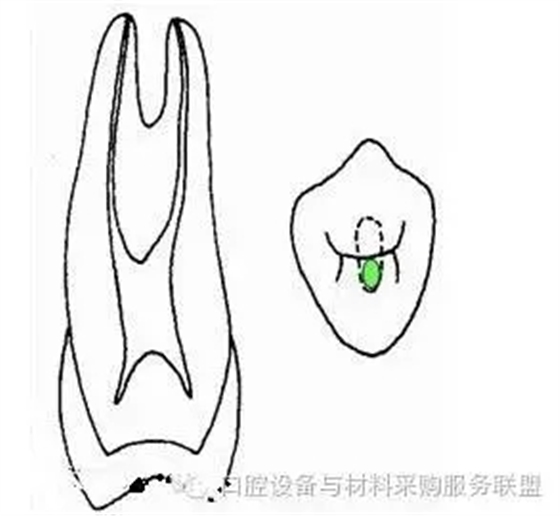 超实用的根管口的探查术