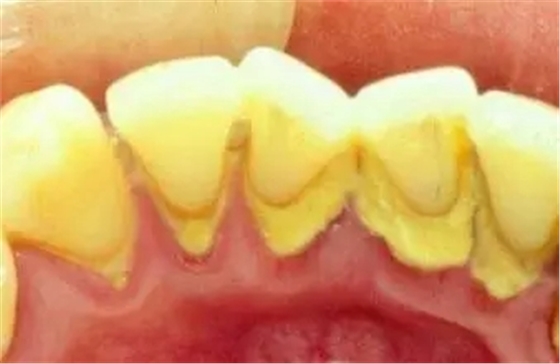 牙结石——不可掉以轻心的口腔"恶魔"