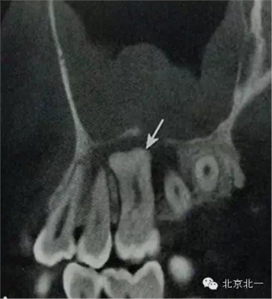 种植遇到骨岛怎么办