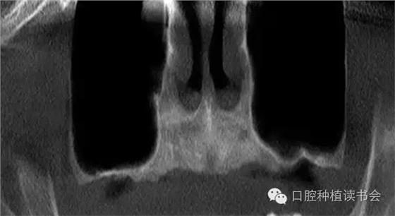 上颌后牙区种植治疗的关键技术之—上颌窦提升术