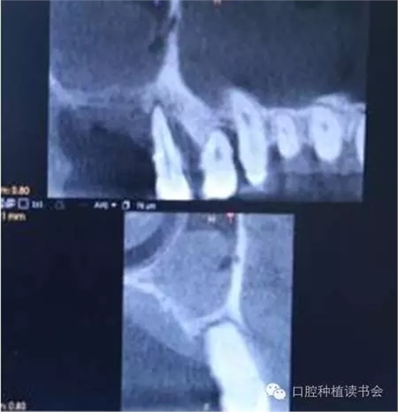 上颌后牙区种植治疗的关键技术之—上颌窦提升术