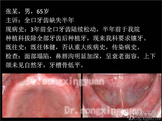 种植牙全口咬合重建