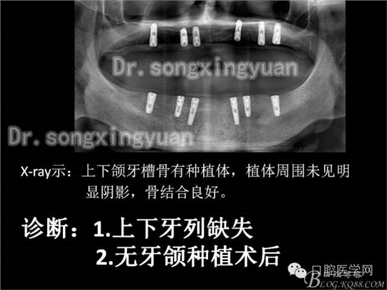 种植牙全口咬合重建