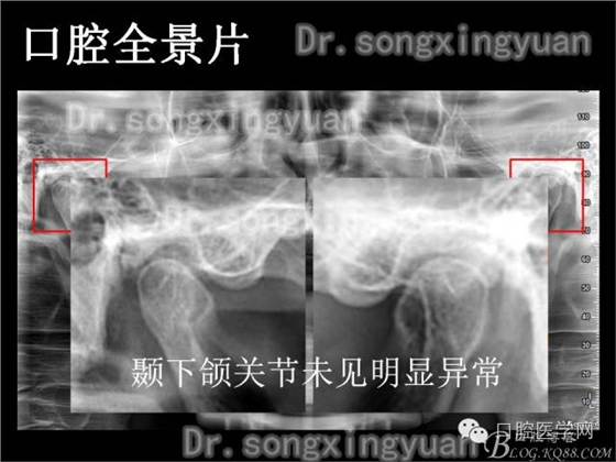 种植牙全口咬合重建