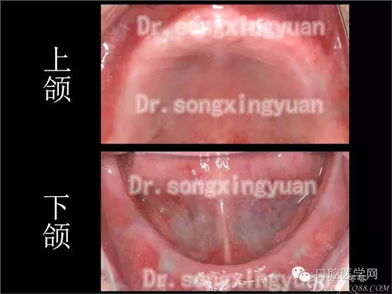 种植牙全口咬合重建