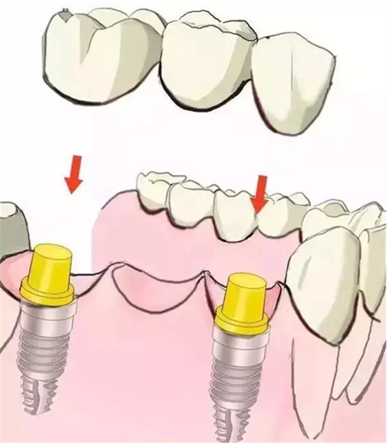 图解：种牙与镶牙的区别，缺牙的赶紧看.png