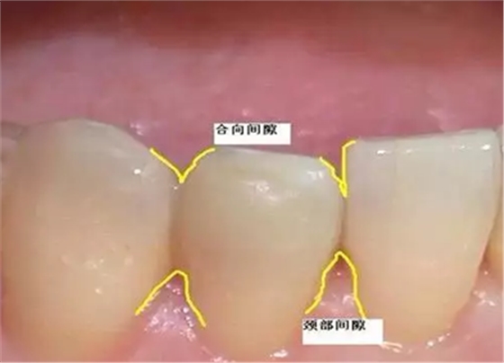 【牙医必知】牙龈乳头—牙间黑三角问题探索|综合病例|陕西嘉友科贸