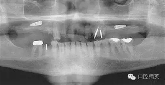 口腔种植各种失败模式的病因探查