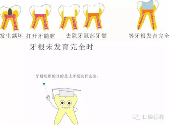 【爱牙科普知识300问】 “什么是活髓切断术？”