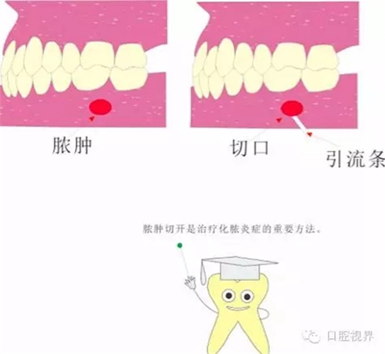 【爱牙科普知识300问】 “什么是活髓切断术？”