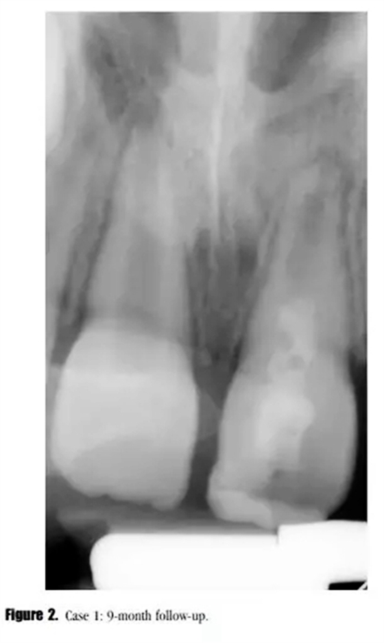 病例分享｜牙髓血管再生治疗失败后的牙根发育：2例