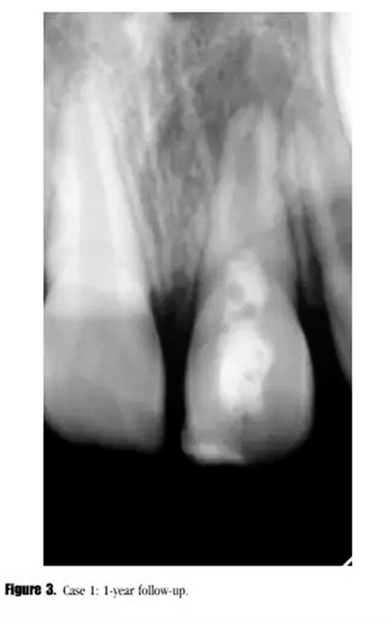 病例分享｜牙髓血管再生治疗失败后的牙根发育：2例