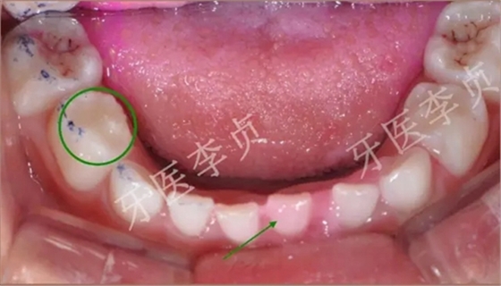 儿牙病例|儿童蛀牙的修复