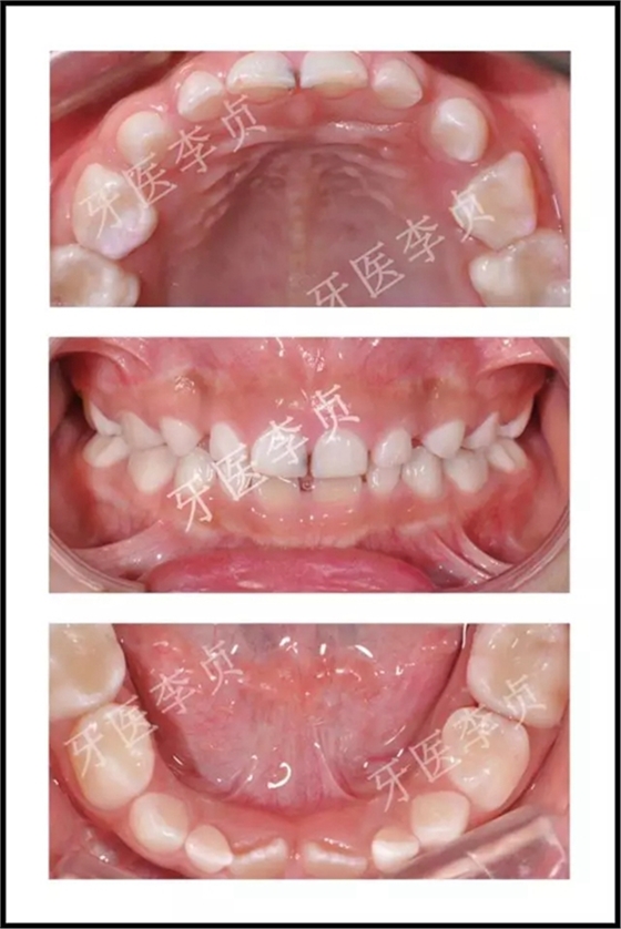 儿牙病例|儿童蛀牙的修复