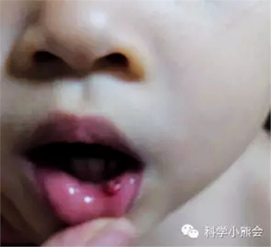 粘液腺囊肿