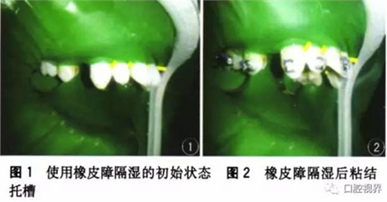 橡皮障，是用还是不用？