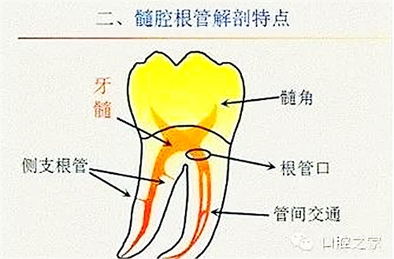 根管治疗之根管口的探查要点  