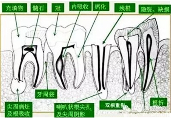 根管治疗之根管口的探查要点  